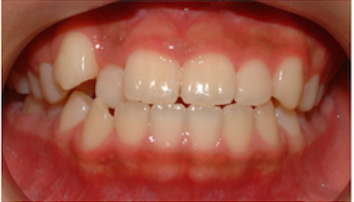 Posle tretmana - stomatološki slučaj 1