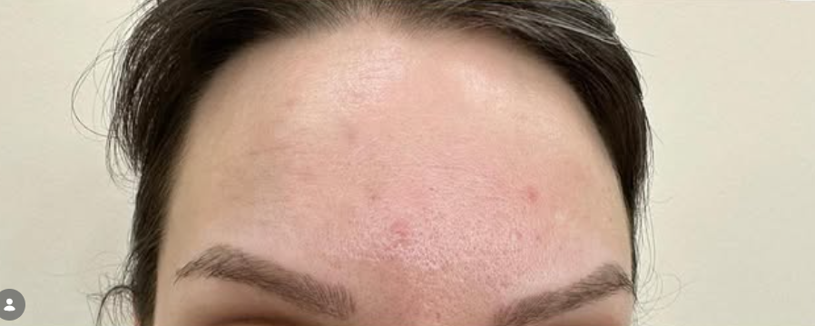 Posle botox tretmana